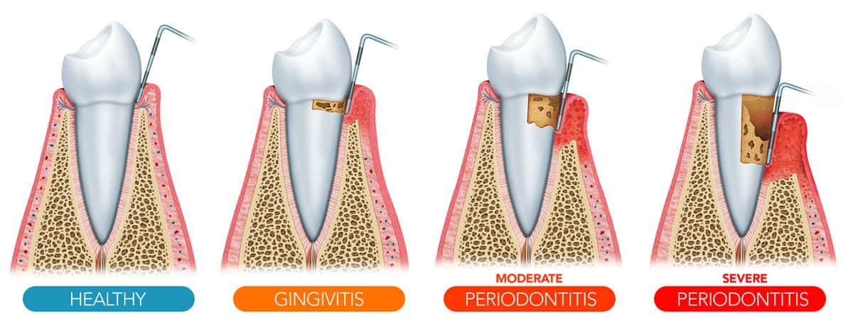 Periodontal Therapy | Non-Surgical Treatment for Gum Disease