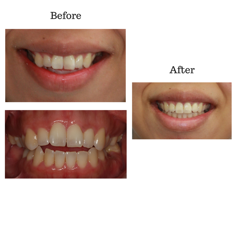 before-and-after-invisalign-1