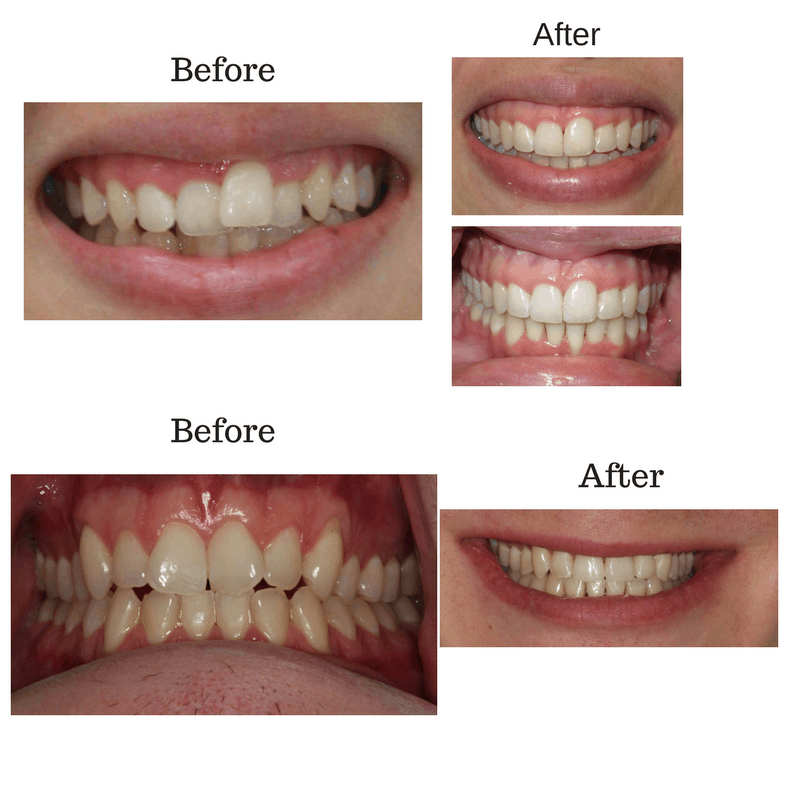 before-and-after-invisalign