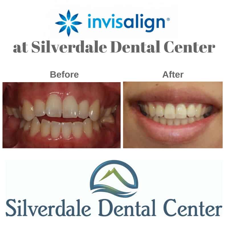 do-you-want-to-know-more-about-invisalign