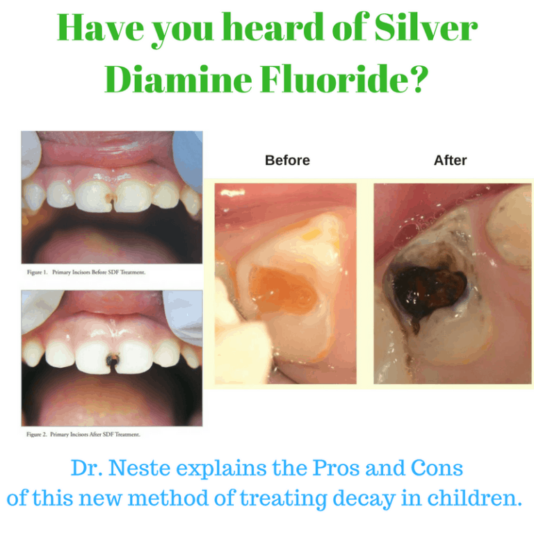 Silver Diamine Fluoride at Silverdale Dental Center for Kids