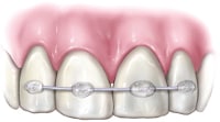 Knocked Out Tooth Repaired7