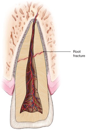 Root Fracture8