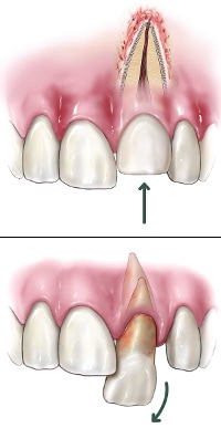 dislodged tooth5