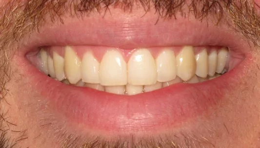 Smile Gallery Dental Treatment | Invisalign After
