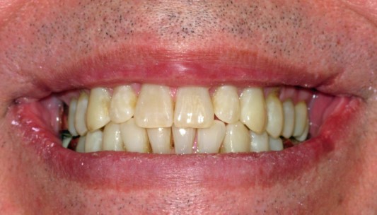 Smile Gallery Dental Treatment | Invisalign Before 
