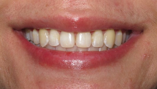 Smile Gallery Dental Treatment | Invisalign After
