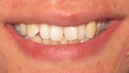 Smile Gallery Dental Treatment | Invisalign After
